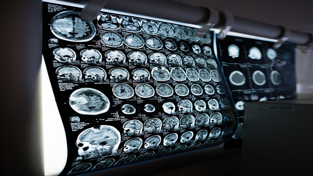 World Stroke Day 2022: Brain strokes can cause immense economic burden on Indian households, experts